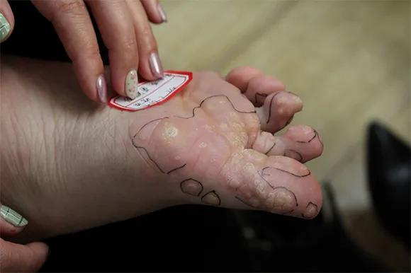 鸡眼和跖疣最明显的区别,鸡眼和跖疣的区别是