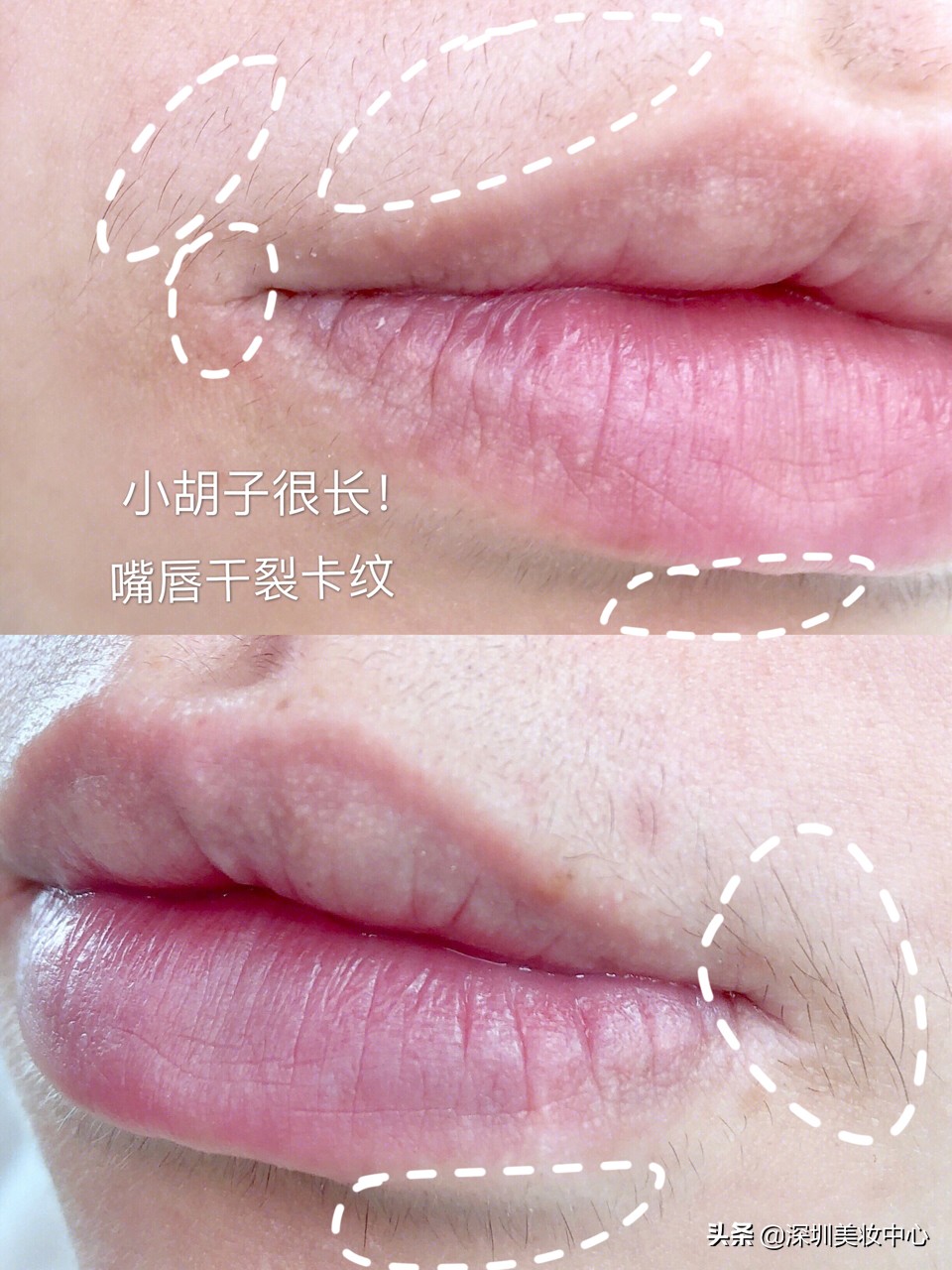 女生有小胡子怎么办小妙招,怎样去除女人嘴唇胡须