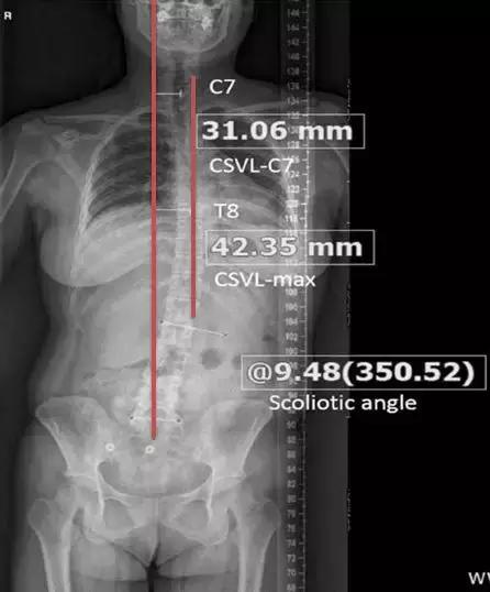 腰突脊柱侧弯最好的恢复方法,腰突为什么会引起侧弯
