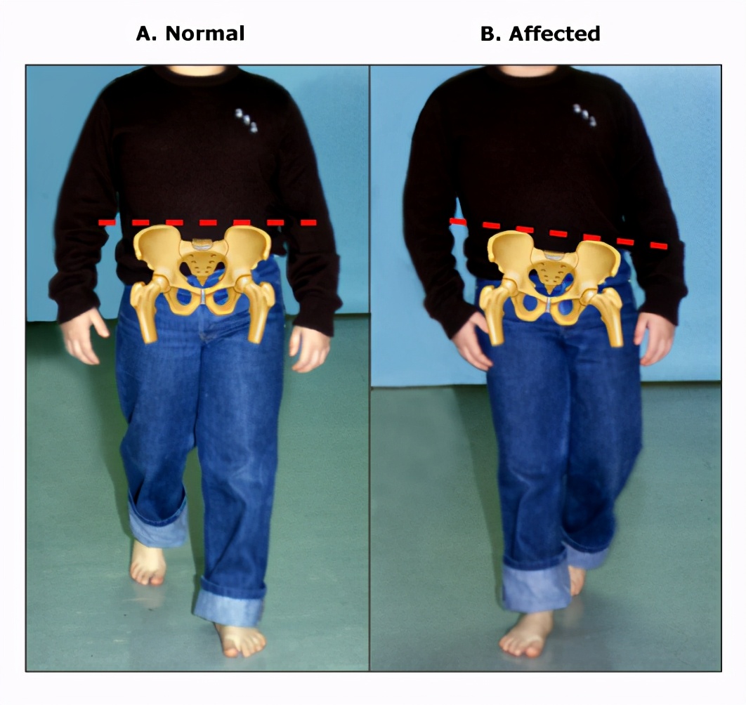 马跛行诊断的影像学方法,儿童跛行诊断流程