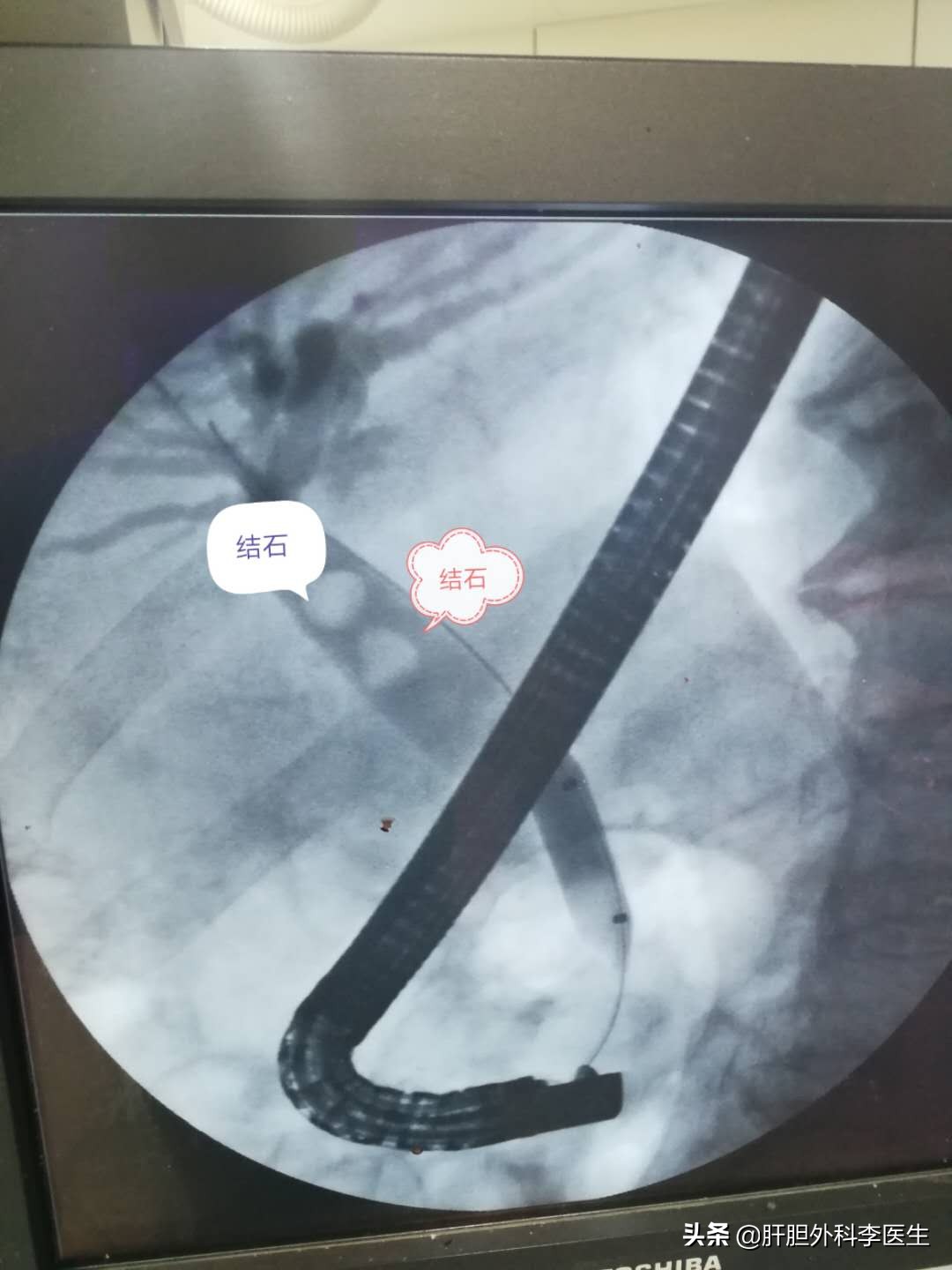 胆囊结石92老人建议做手术吗,九十多岁的老人胆管结石怎么办