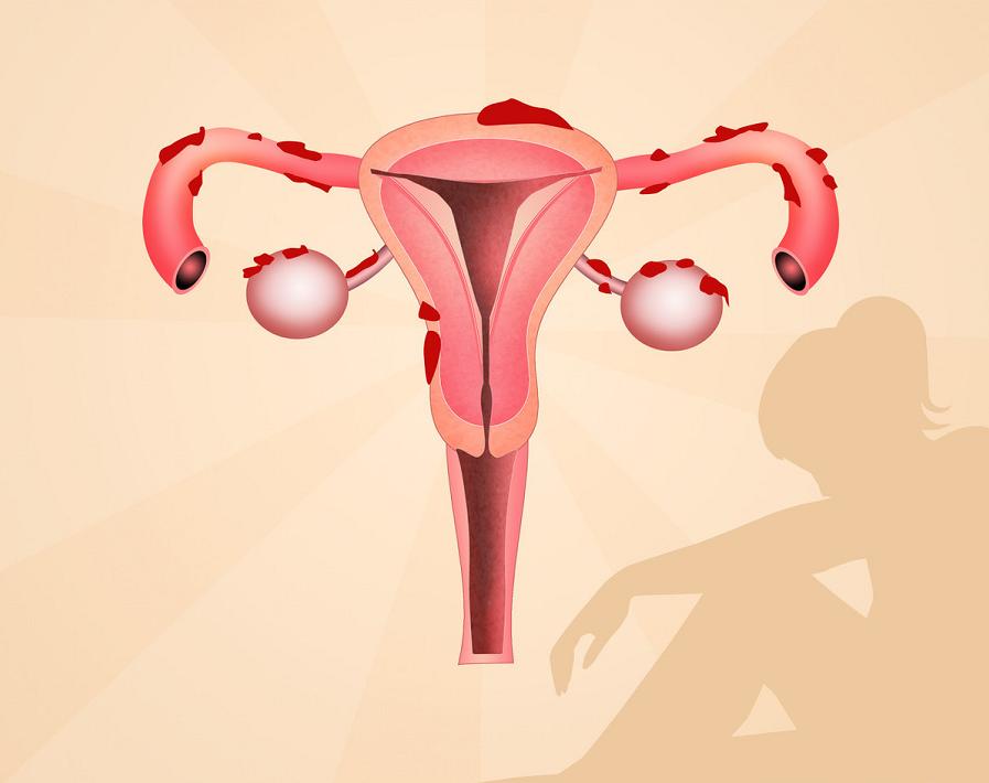 怎么锻炼或饮食可以消除子宫肌瘤,子宫肌瘤日常生活中要注意什么