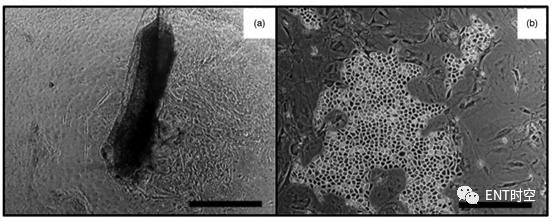 鼓膜再生,耳膜再生复原技术