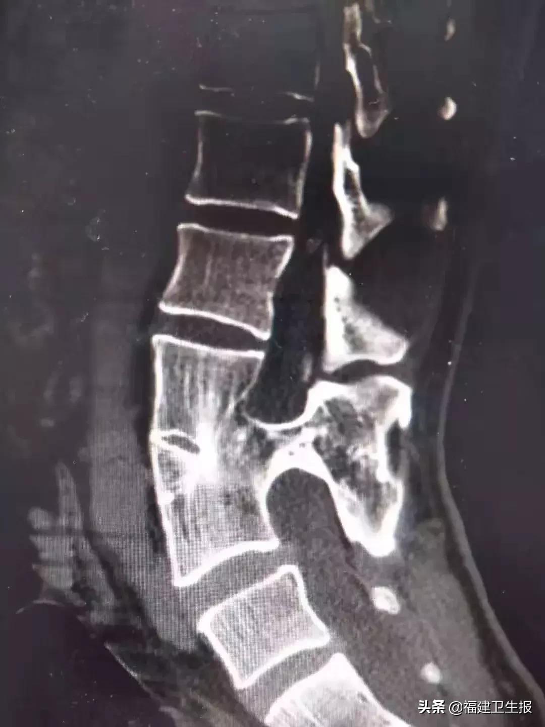 男子腿脚不便站不起来,男子莫名下肢乏力行走困难