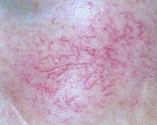 脸上红血丝怎么修复可以彻底治愈,血丝怎么能快速消除