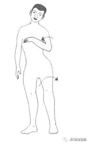 分期针刺治疗脑卒中后肢体功能障碍