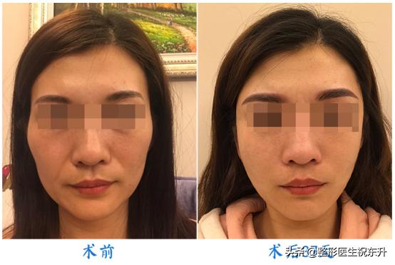 面部五层提升可以维持多久,做完面部提升三件套