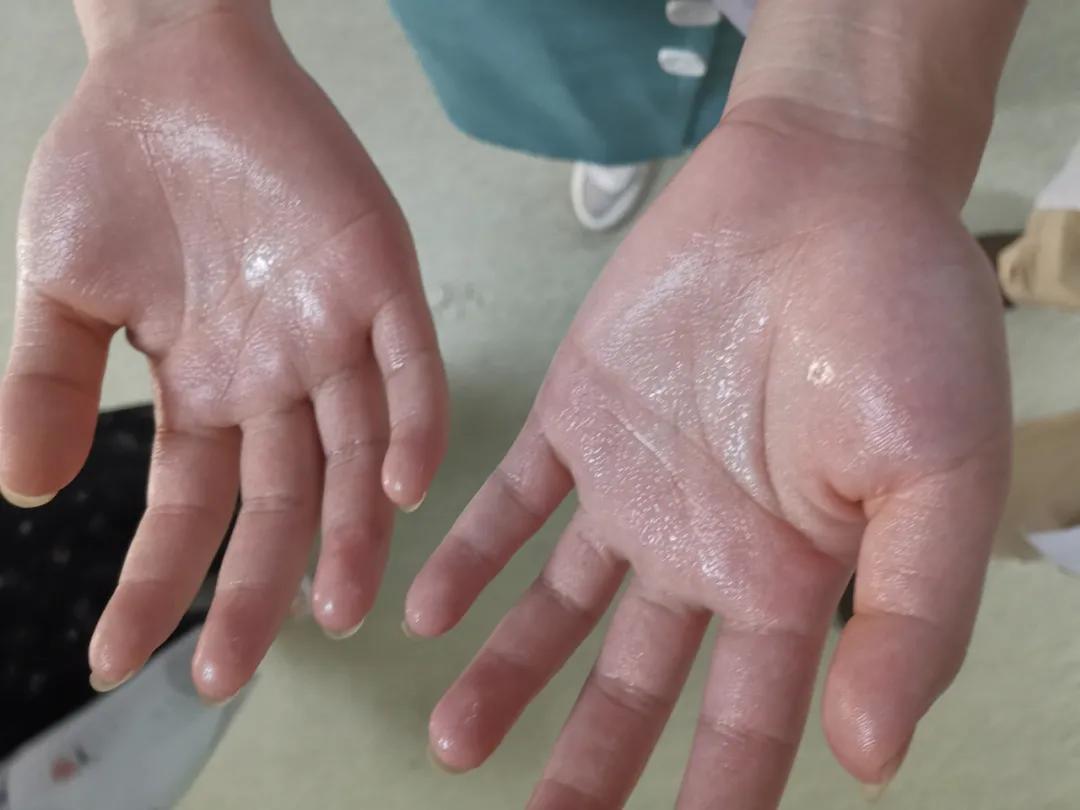 手汗症和胸外科有什么关系,手汗症胸外科手术全过程