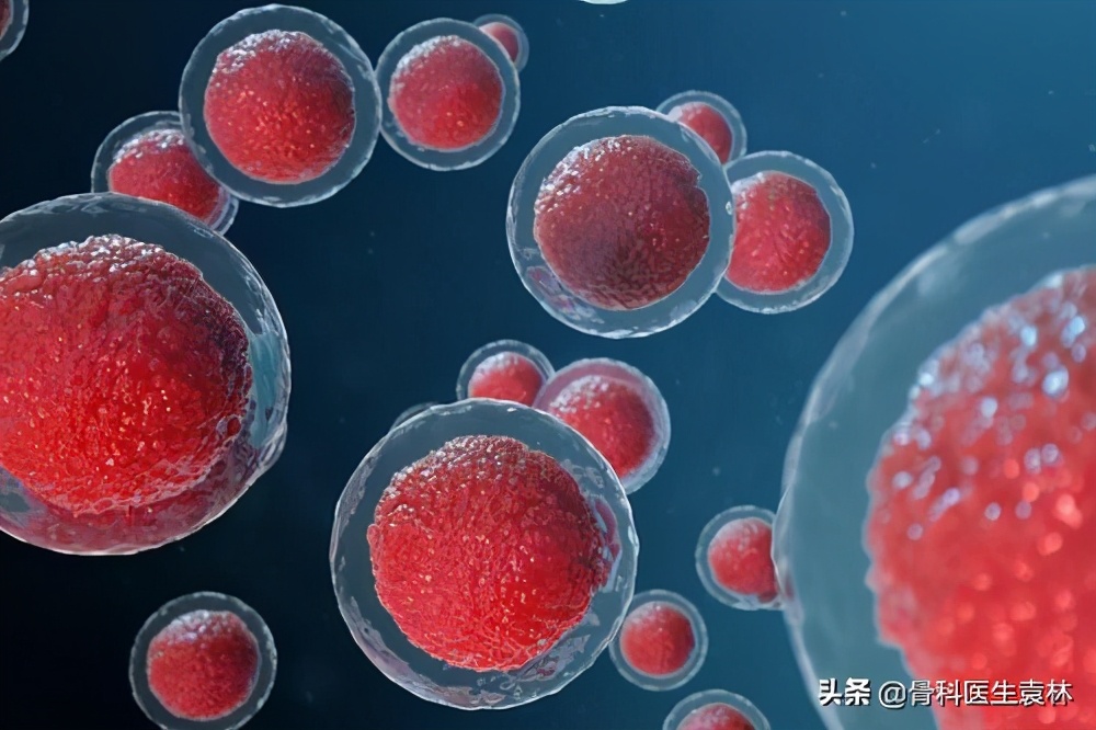 骨科无菌性炎症,关节无菌性炎症是怎么引起的