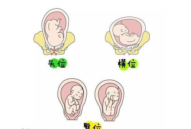 从孕28周到35周胎儿都是臀位,28周臀位脐带绕一圈还能转过来吗