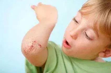 伤口擦伤的皮要不要剪掉,皮肤擦伤伤口流水是什么原因