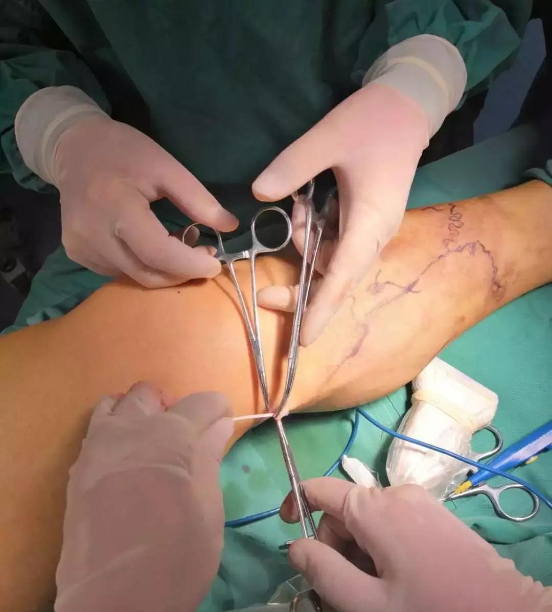 小针孔,小针眼最佳治疗方法