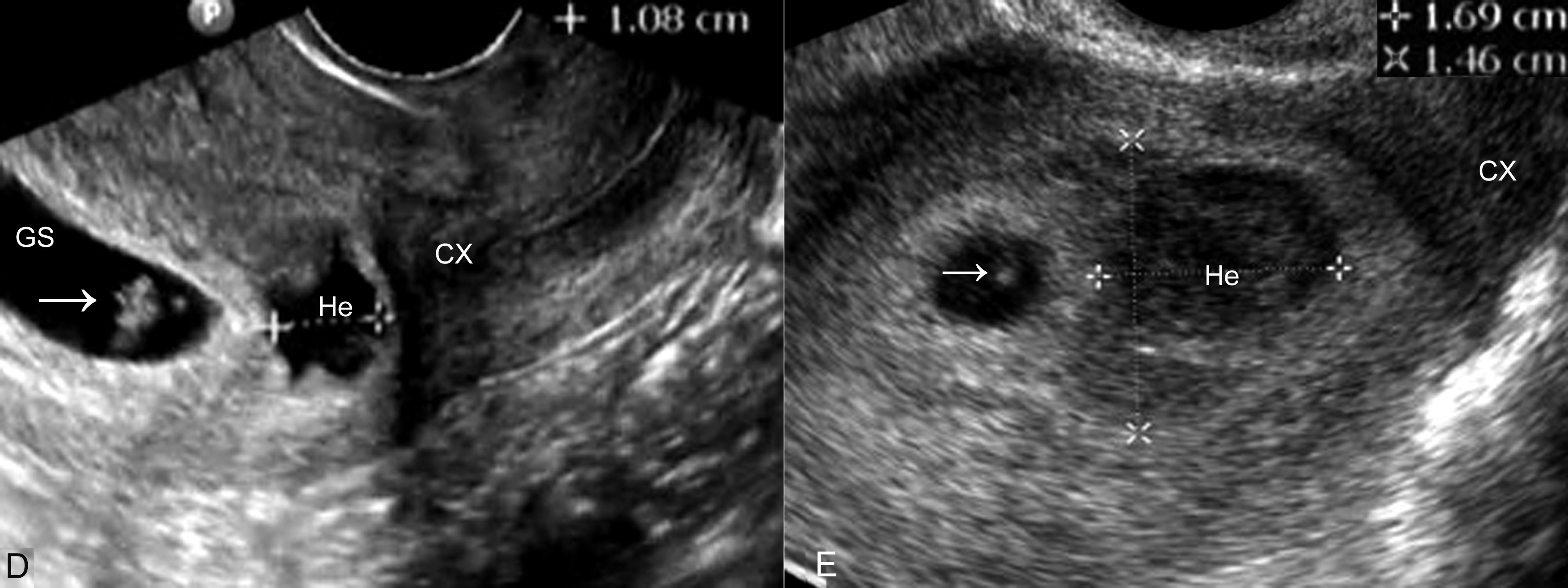 经阴超声检查可以看出来流产吗,流产残留超声诊断