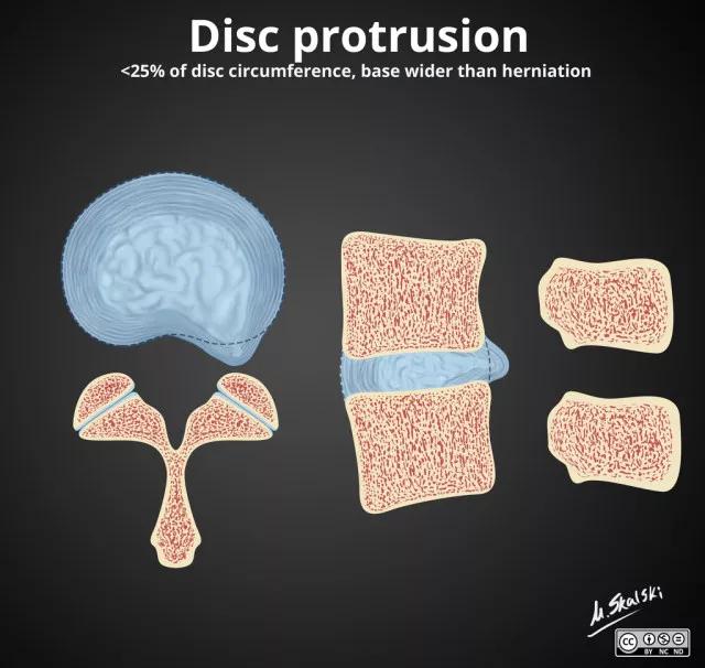 椎间盘膨出影像学表现,椎间盘脱出和突出鉴别影像学表现