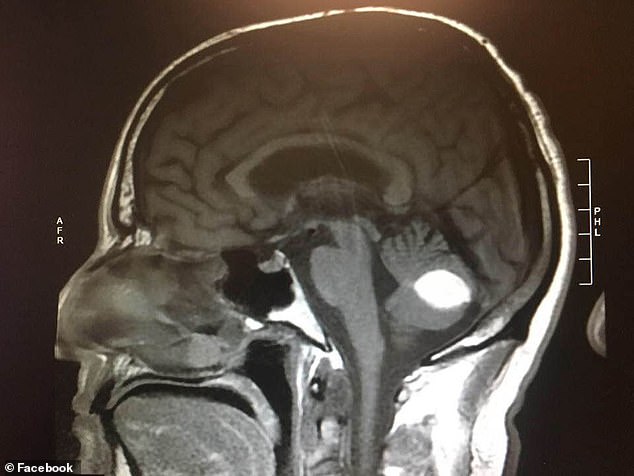 美国男子治疗癌症晚期,26岁男孩身患恶性脑瘤
