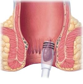 内痔怎么治，教你这个小妙招，让你不再菊花残