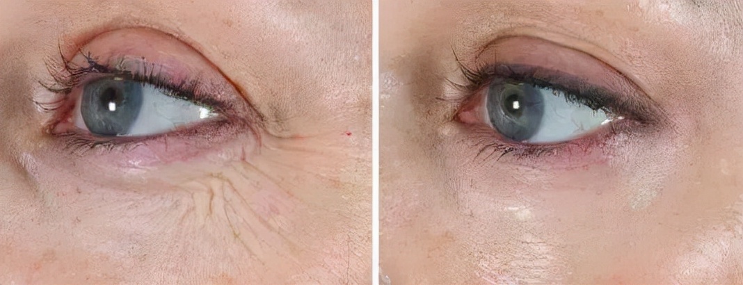 抬头纹鱼尾纹法令纹哪个更显老,抬头纹鱼尾纹法令纹颈纹一样没少