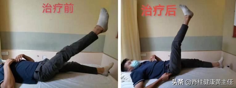 腰椎间盘突出才20岁怎么矫正,腰椎间盘突出7mm可以保守治疗吗