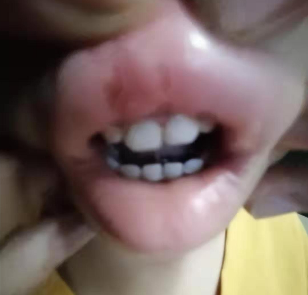 牙齿受外伤怎么办,牙齿外伤了该如何预防处理