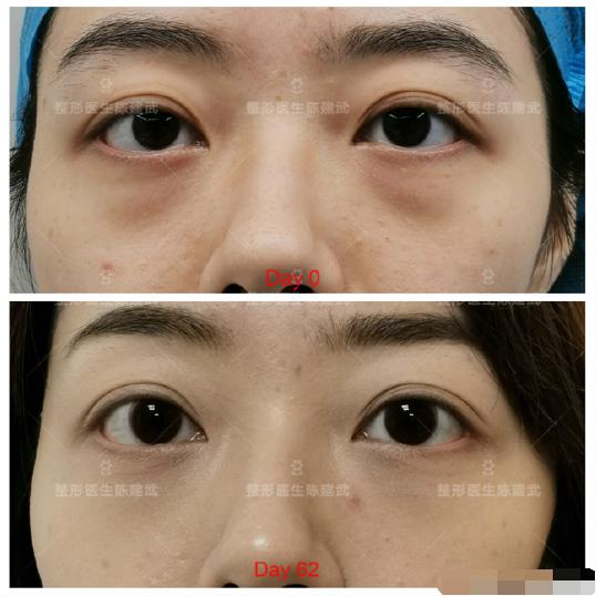 为什么睡那么早眼袋还是那么重,天天睡不好眼圈和黑眼袋特别重