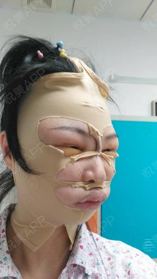 那些削骨的女明星怎么样了,哪些明星承认削骨了