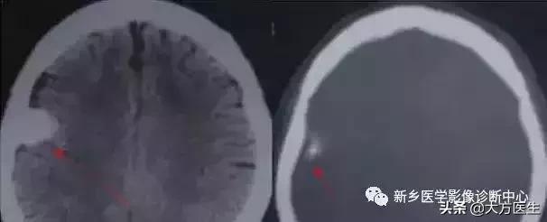 钙化灶是良性肿瘤的可能性大吗,颅内肿瘤钙化发生率最高