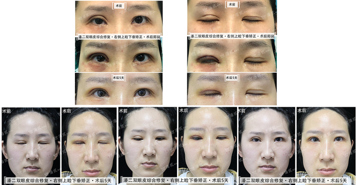 双眼皮术后恢复不一致正常吗,双眼皮术后看着不对称