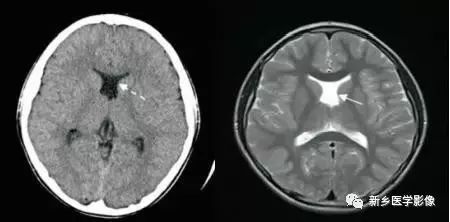 影像学脑室扩大,脑室显大怎么理解