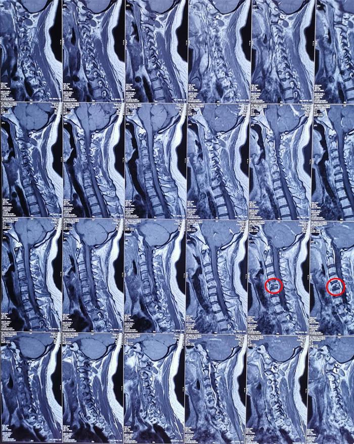 因颈背部疼痛、上臂抽疼,检查出颈5椎体结核