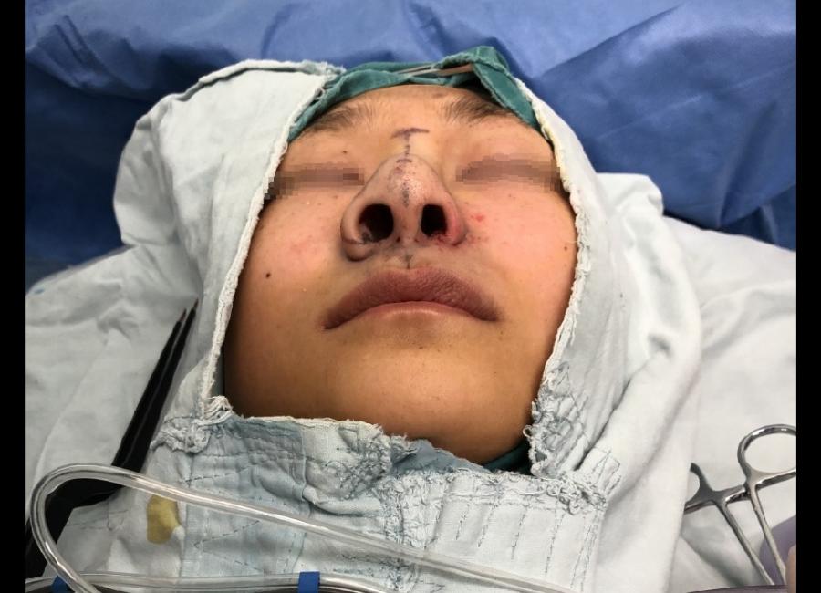 鼻翼缩小内缩和外缩的区别,鼻头缩小和鼻翼缩小是一个手术吗