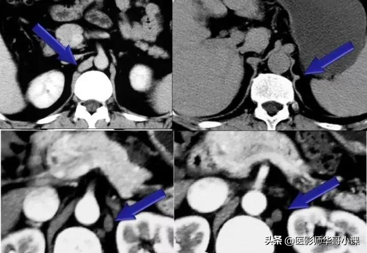 「精品课件」胸部膈肌的解剖及常见病变影像的表现