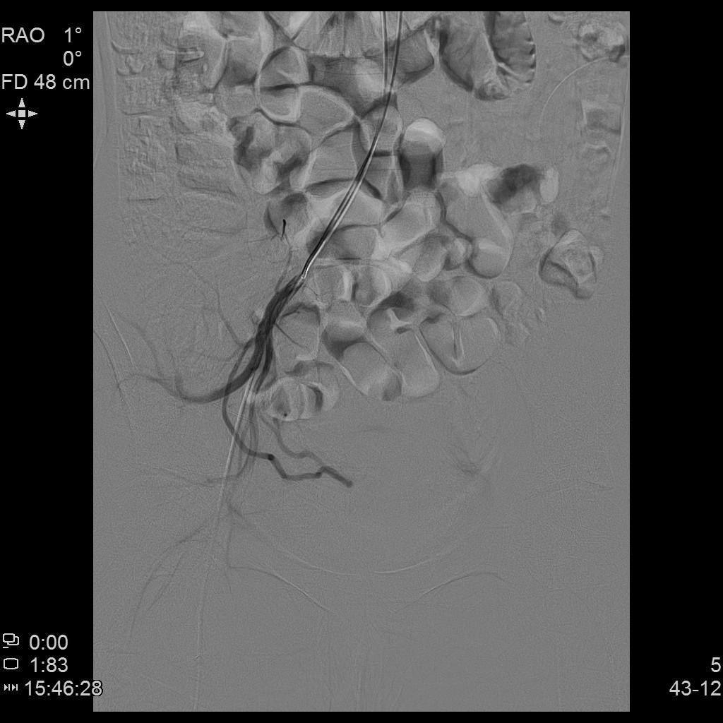 子宫腺肌症称为不死的癌症,子宫腺肌症是不死的癌症吗