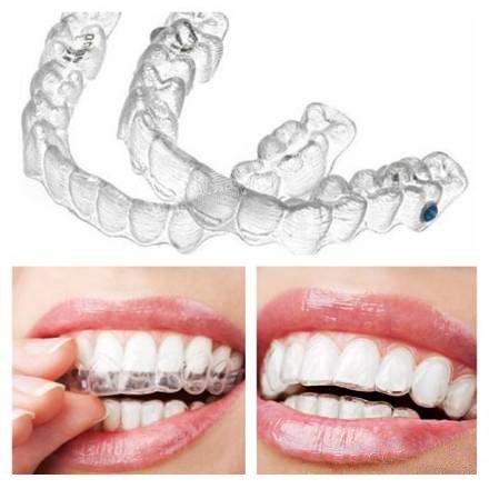 陶瓷还能用来做矫正?怎么做到的?