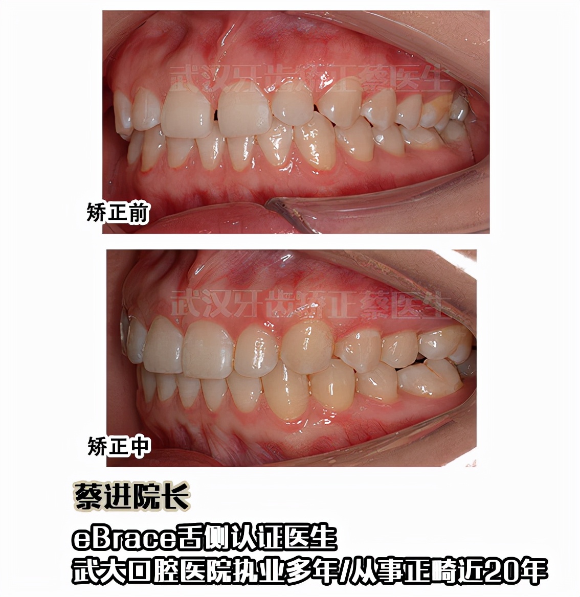 武汉矫正牙齿去哪里做最好,武汉成人牙齿矫正牙齿不齐