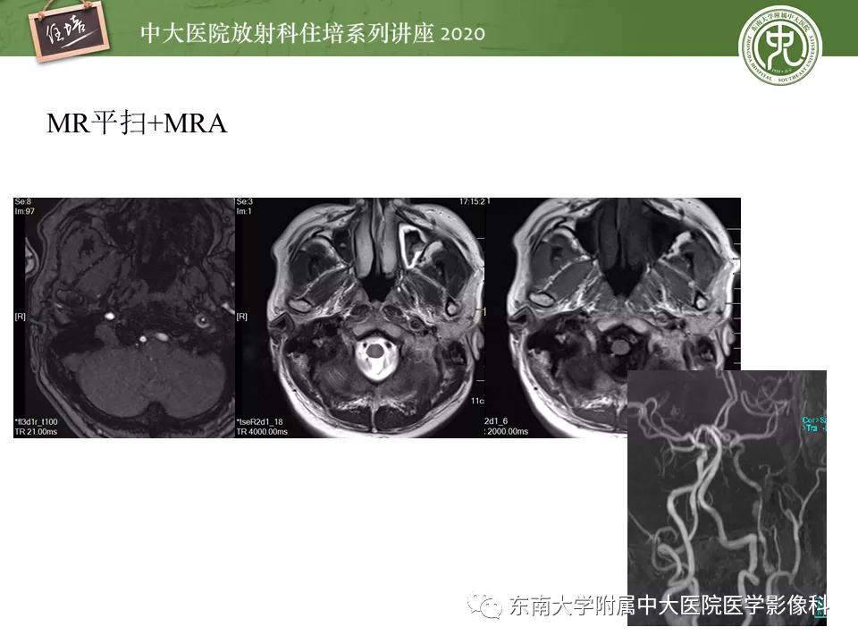 颈动脉夹层的超声表现及漏诊分析,动脉夹层与夹层动脉瘤是一样的吗