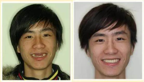 医生说我少一颗牙怎么回事,医生说我少了一颗牙