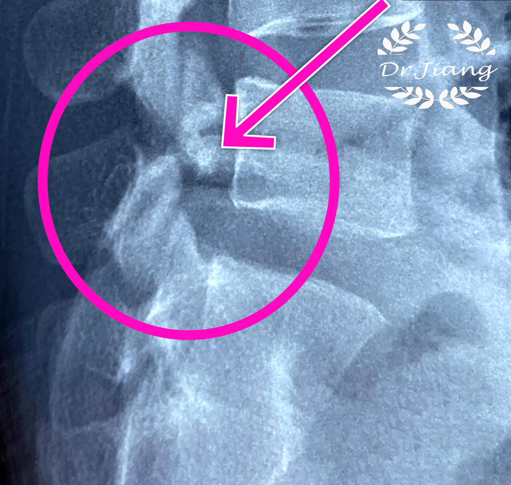 青少年脊柱弯曲危害科普视频,脊柱病科普小常识大全