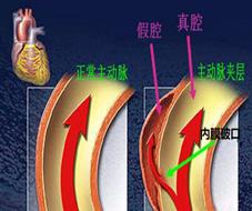致命的主动脉夹层,主动脉夹层最危险的生命杀手