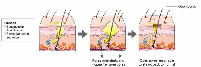 靠护肤品真能缩小毛孔吗,护肤品是怎么让毛孔缩小的