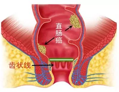 便血感觉屁股上有个小肉球,便血直肠有肿块
