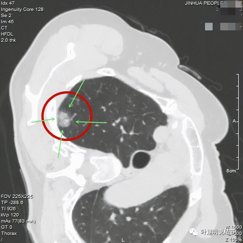 从活检怎么看是非小细胞癌,从病例谈辨证论治