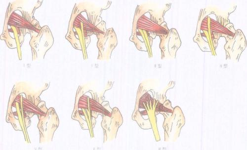 梨状肌和腰椎疼的区别,梨状肌和腰椎间盘有什么区别