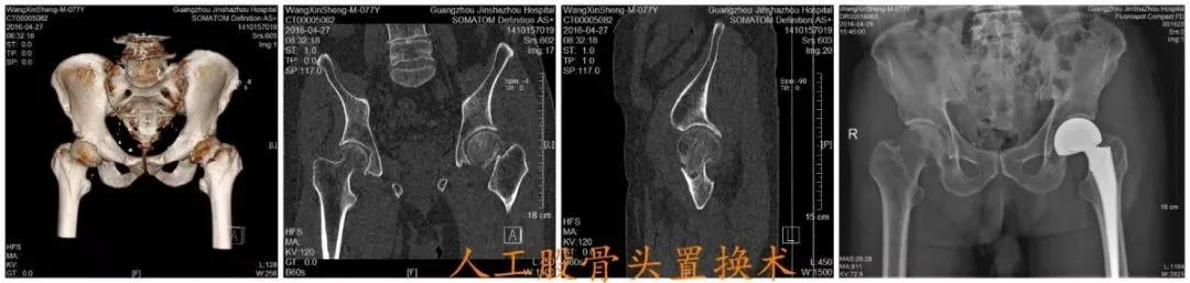 老年人跌倒后髋部疼痛是什么骨折,老人髋部骨折不治后果严重吗