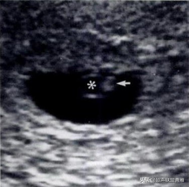 3毫米卵黄囊未见胎芽正常么,40多天的卵黄囊