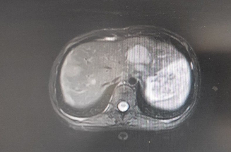 女子子宫内膜癌,22岁子宫内膜癌