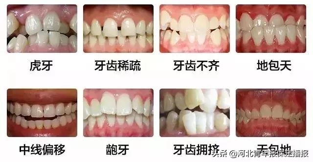 保定普通隐形牙套,保定隐形牙套矫正