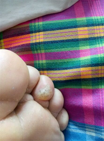 脚气好不了查什么,脚气很重谁知道怎么治疗