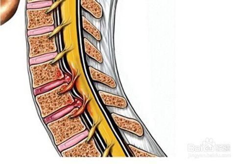 腰椎骨质增生最好的睡觉方法,腰椎骨质增生怎么造成的