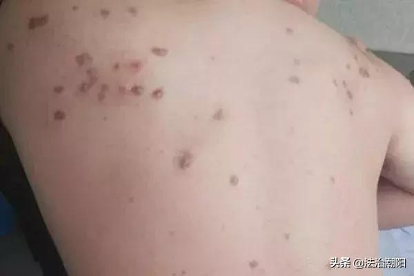 *毒冰**疮、*古麻**痘，拿什么来拯救这张脸？