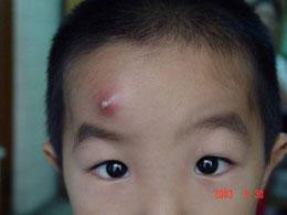 战痘的正确方法图解,五个“战痘”小妙招